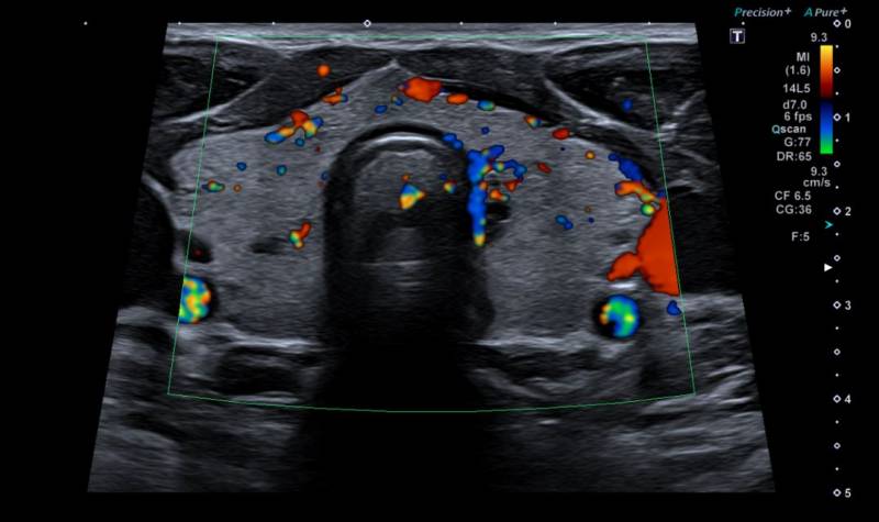 Réaliser une échographie de la glande thyroïde